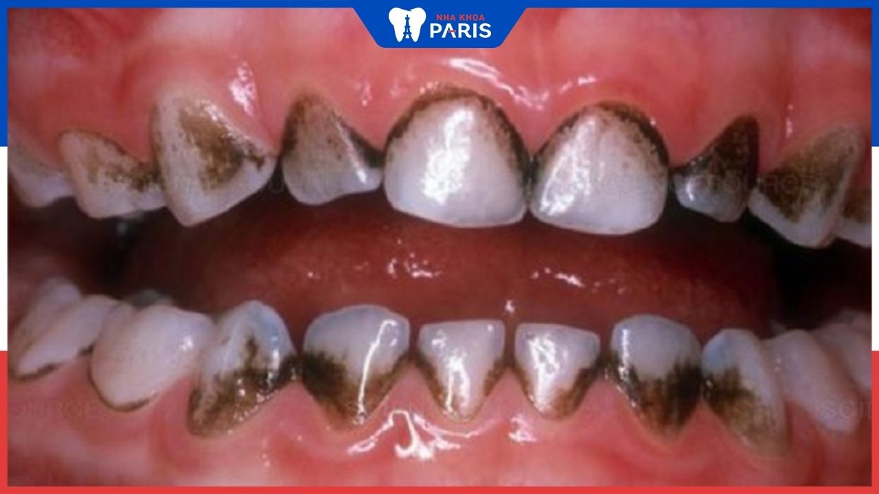 Răng có chấm đen phải làm sao? Gây ảnh hưởng gì